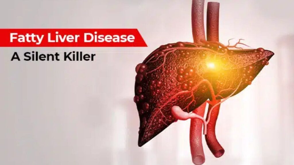 Doctor explains: How lifestyle choices and genetics are causing an alarming rise in fatty liver disease